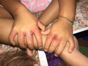 Menina de 3 anos contrai infecção dolorosa após passar o aniversário em Key Biscayne