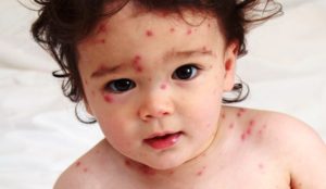 vacina catapora antivacina criança