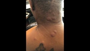 Mulher alega que foi picada por bedbugs em hotel da Disney